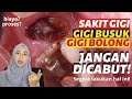 Lengkap! PERAWATAN SALURAN AKAR GIGI 2022 (Biaya, Proses, dll) #tanyadoktergigimuda