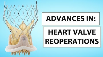 Advances in Heart Valve Reoperations Webinar with Dr. Charles Davidson & Dr. Christopher Mehta