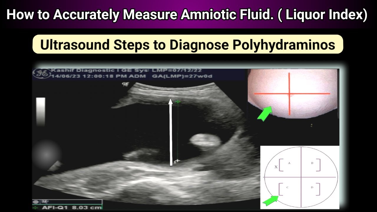Ultrasound Pregnancy How to Measure Amniotic Fluid Accurately ( Fluid around Baby