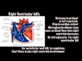 Tintinalli's Emergency Medicine, 8th edition video - ECG  Right Ventricular MI