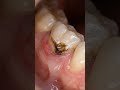 Gumline Rot Shock” – Cervical Decay Along Gum MarginHashtags:#GumlineRot #DentalDecay #CervicalCarie