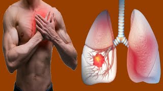 Causes Of Chest Pain From Lung Cancer