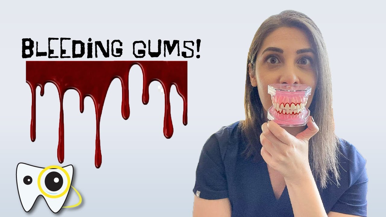 Bleeding Gums! Why do your gums bleed and how to treat them YouTube