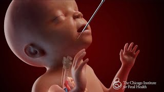 FETO Surgery in Utero - The Chicago Institute for Fetal Health at Lurie Children’s