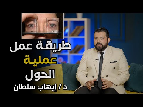 ازاي عملية الحول بتتعمل د إيهاب سلطان