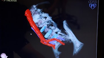 Mayo Clinic Minute – What is Augmented reality spine surgery?