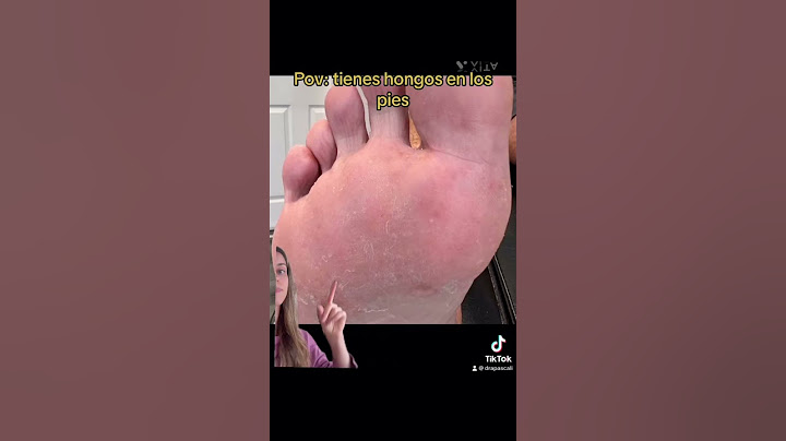 Tienes hongos en los pies #shortamv