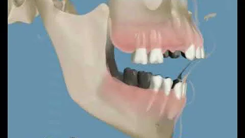 Película sobre la separación de los dientes anteriores