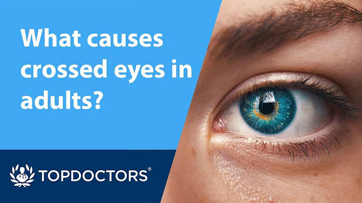 What causes crossed eyes in adults? - DayDayNews