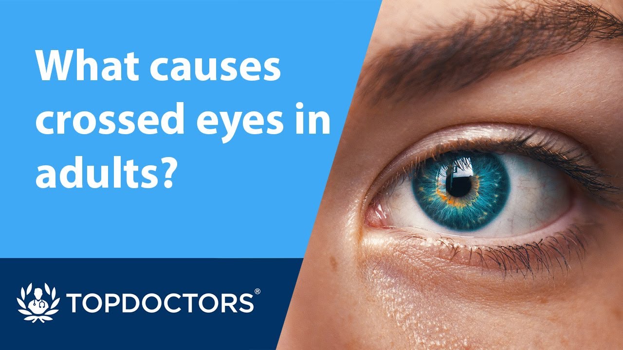 what-causes-crossed-eyes-in-adults-youtube