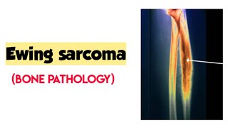 Ewing sarcoma/Bone pathology/Robbins pathology/Bone tumors/forward focused screenshot 4