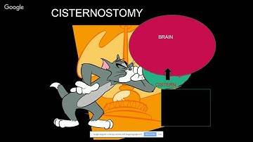 Iype Cherian MD: Cisterostomy Review