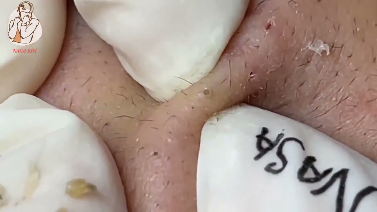 Satisfying Blackhead Removal of Monster Size on Face