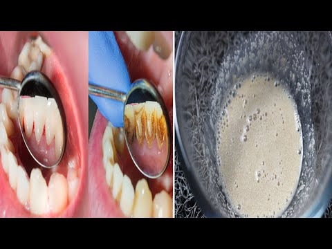 Video: 3 manieren om tandplak te verwijderen