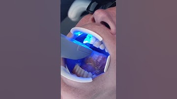 Digital impression scanner | Dentistry | Dentist #shorts #health #beauty