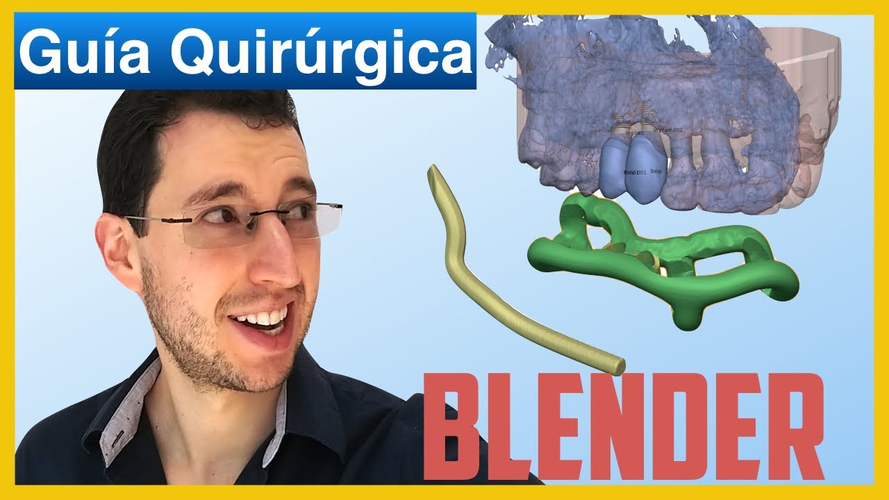 Guía quirúrgica para implantes dentales