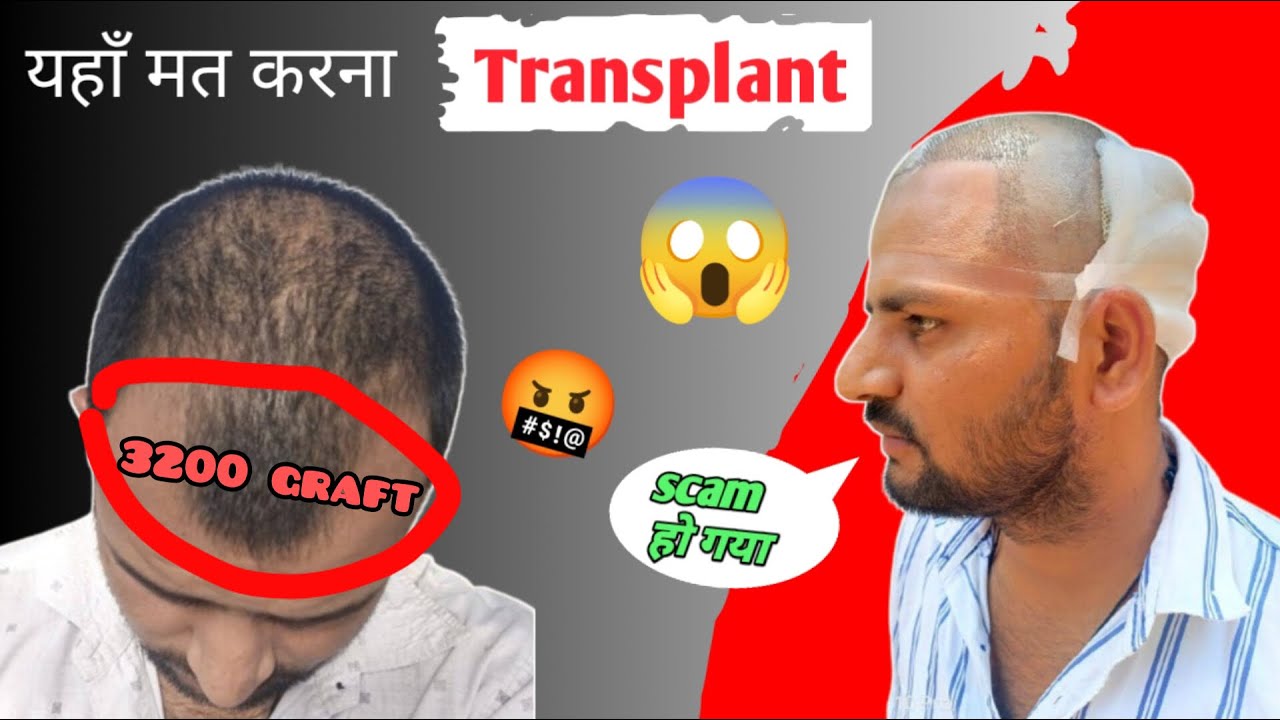 hairtransplant hair Hair Transplant Surgery / Hair Transplant Ke Bad