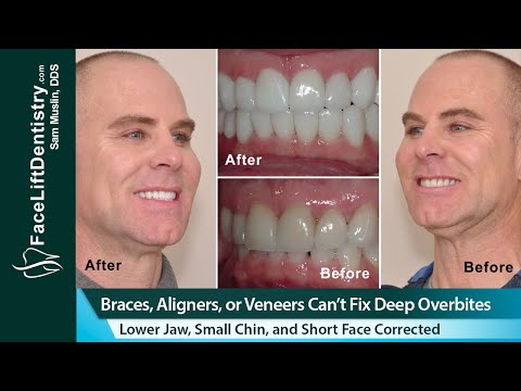 How to Get Rid of an Unsightly Overbite for Good, Byte®