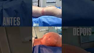 Paciente De 50 Anos E O Glúteo Dos Sonhos