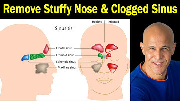 4 Proven Techniques for Stuffy Nose & Clogged Sinus - Dr. Alan Mandell, D.C.