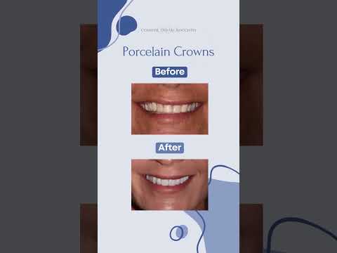 Before and After Porcelain Crowns