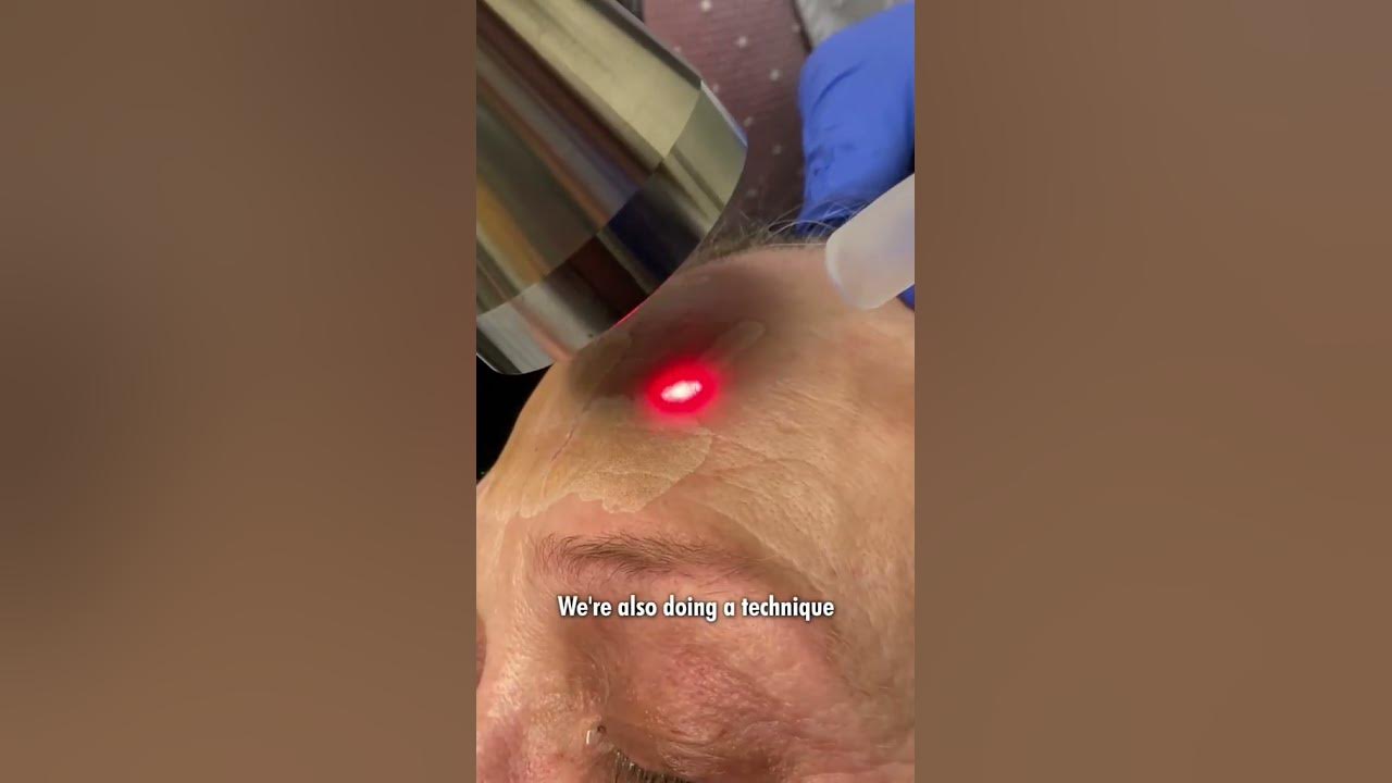 Fully Ablative Erbium Laser Demonstration For Skin Resurfacing and Skin