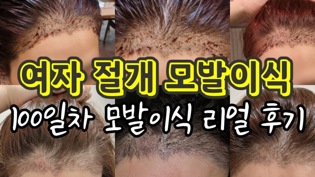 여자모발이식 헤어라인 절개모발이식 리얼후기 100일차소감#모발이식후기 #절개모발이식  #모낭염 #암흑기