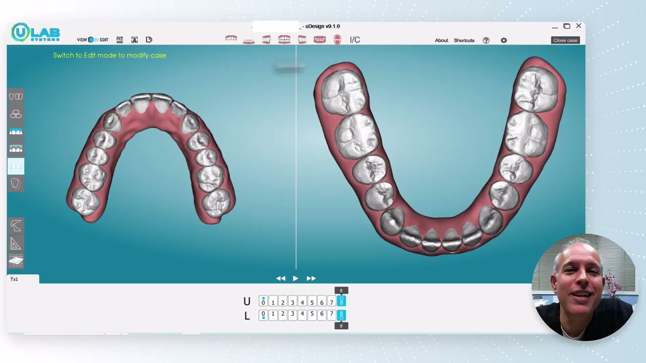 ARA Ortho Case Of The Week - Anterior Crossbite Correction With Clear Aligners