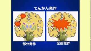 あなたの保健・医学講座：高齢者のてんかん（2012.6 ）