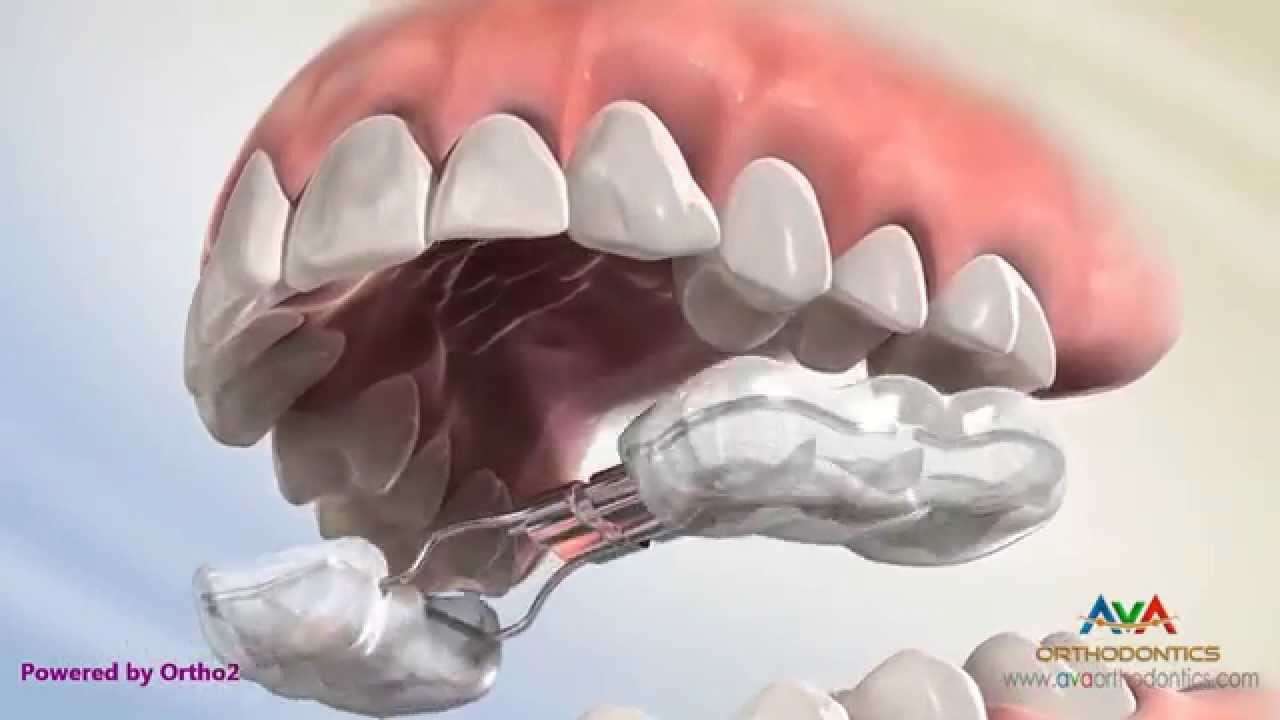 Soorten beugels – Orthodontist