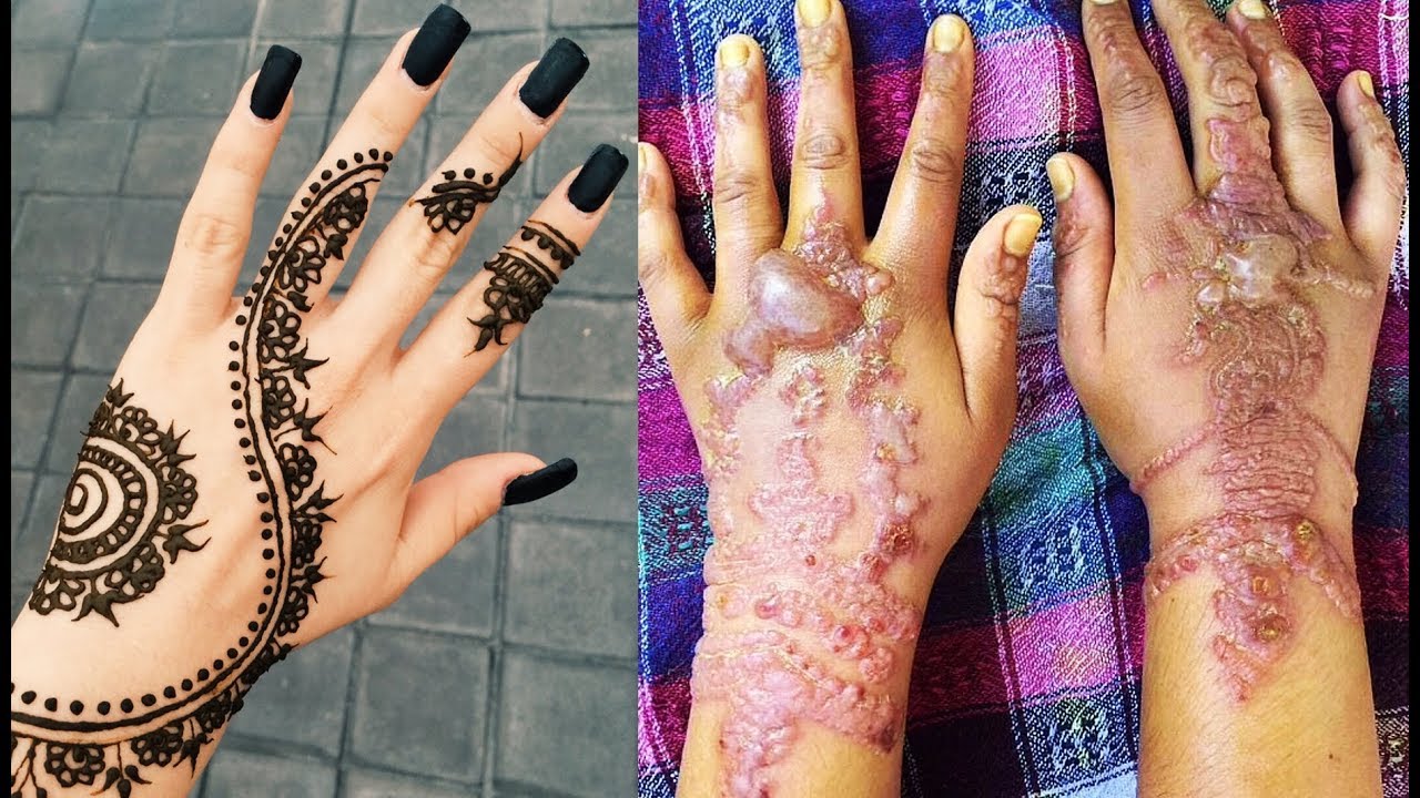 Temporary Black Henna Tattoos Can Be Painfully Permanent Youtube