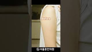 얇은 팔 만들기, 팔지방흡입 수술 전후 #지방흡입
