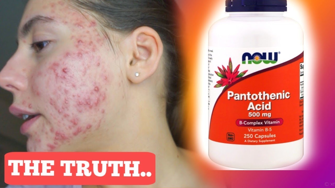how much pantothenic acid for acne