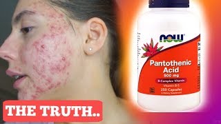 I TOOK PANTOTHENIC ACID FOR ONE MONTH STRAIGHT || THIS IS WHAT ACTUALLY HAPPENED TO MY ACNE..