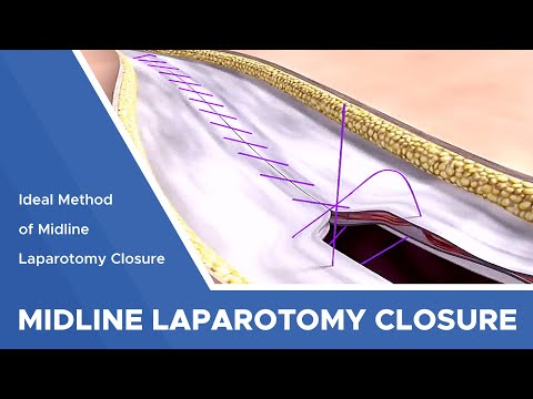 Search for an Ideal Method of Midline Laparotomy Closure: Continuous, Large Bite Technique
