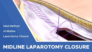 Search For An Ideal Method Of Midline Laparotomy Closure Continuous Large Bite Technique