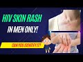 how to identify HIV rash in men?