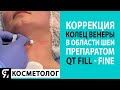 Коррекция колец Венеры в области шеи препаратом QT Fill - Fine. Константин Барыкин.