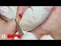 |299| Blackheads & Acne treatment in Ha Quyen Spa on 24/9/2020 Part 2 -Điều trị mụn tại Hà Quyên spa