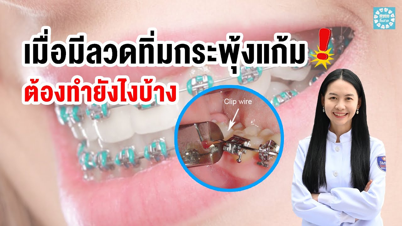 เมื่อมีลวดทิ่มกระพุ้งแก้ม ต้องทำยังไงบ้าง | หมอหนิงมีคำตอบ