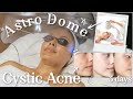 Oxygen Therapy Facial for Breakouts &amp; Cystic Acne | Skincare Treatments ft. OxygenCeuticals!