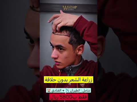 تجربة زراعة الشعر للمشهور طوني الشمري في عيادة واثق كلينك في تركيا 966504358697 
