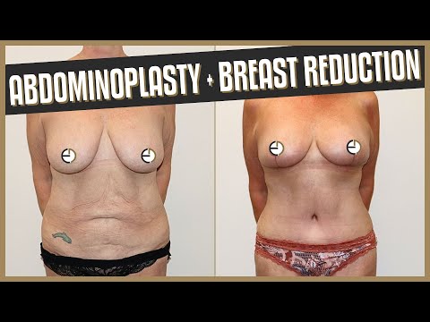 Post-Pregnancy Surgery Abdominoplasty and Breast Lift (Mastopexy)