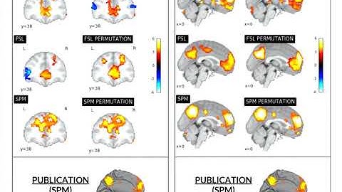OHBM 2018 | Oral Session | Alexander Bowring | Same Data - Different Software - Different Results?…