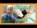 Hmatome popping  medical group auburn