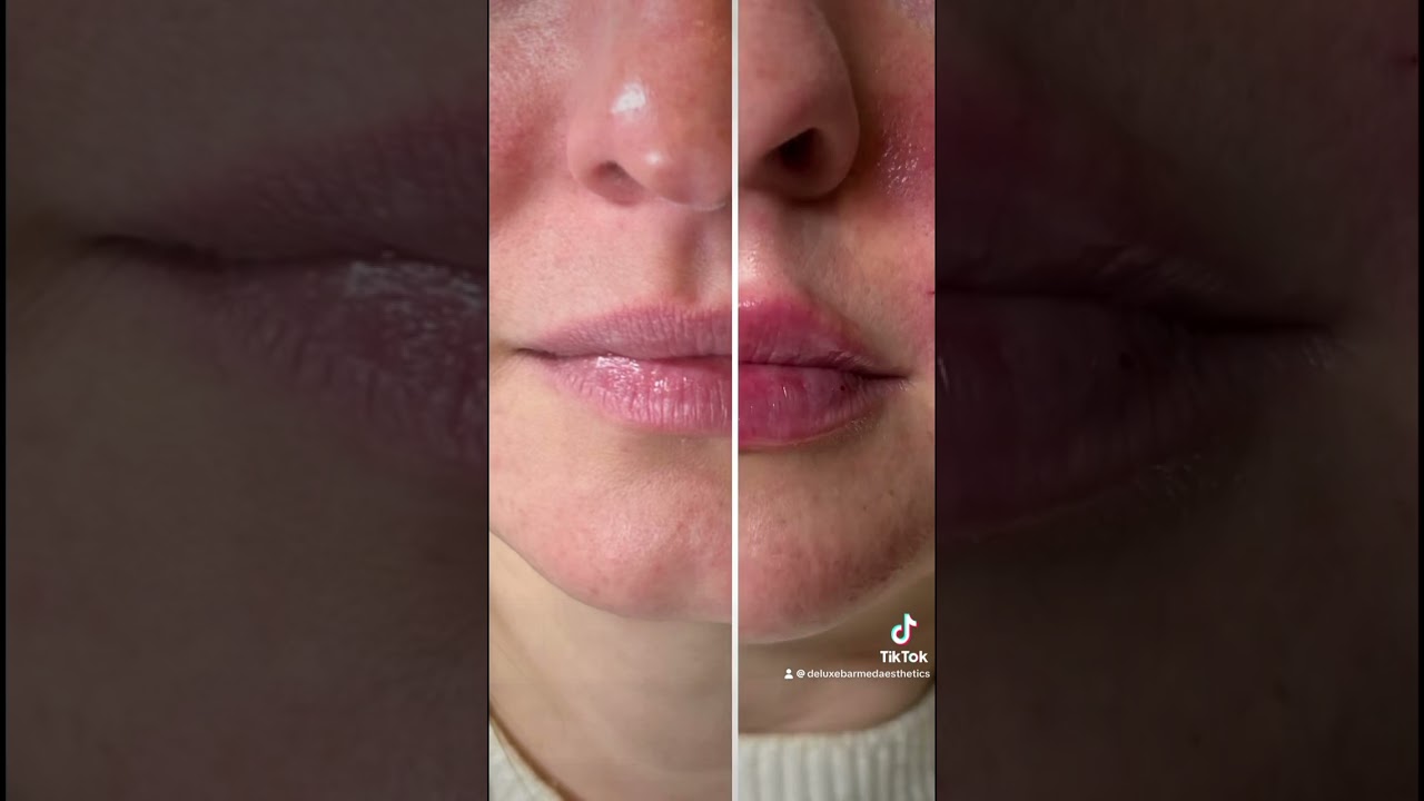 Juvederm Ultra Plus for Lip Filler at DeluxeBar. Call to book 781-561-0076