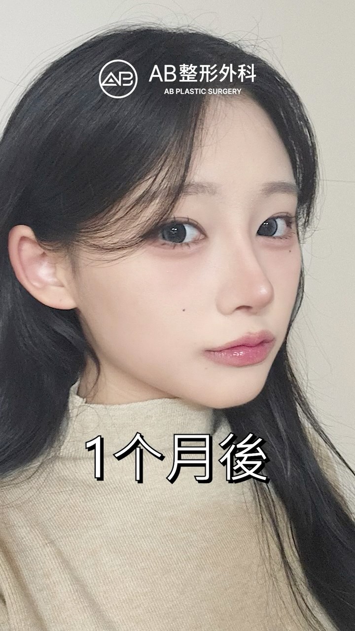 眼整形 鼻整形後變得超精緻✨ #Shorts