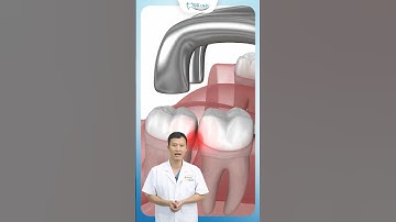 Ngỡ Ngàng Khi Răng Khôn Mọc Lệch | Bác Sĩ Yên