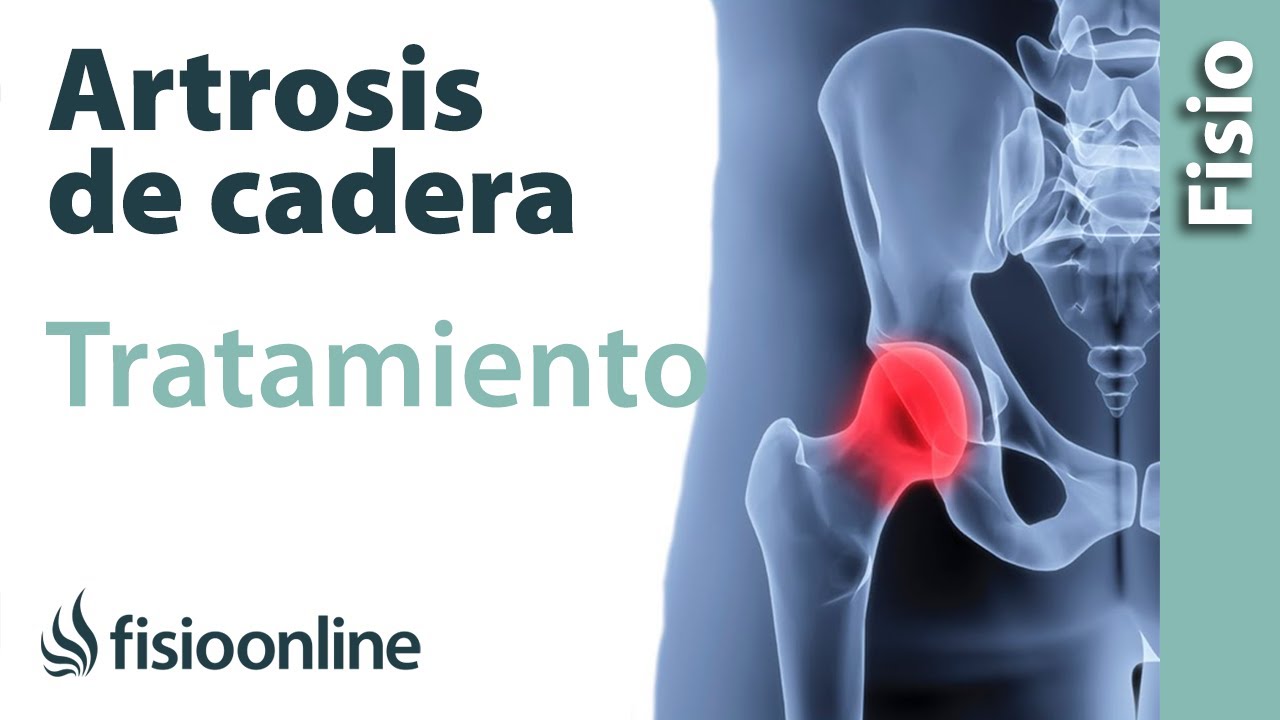 remedios naturales para la artrosis de rodilla y cadera