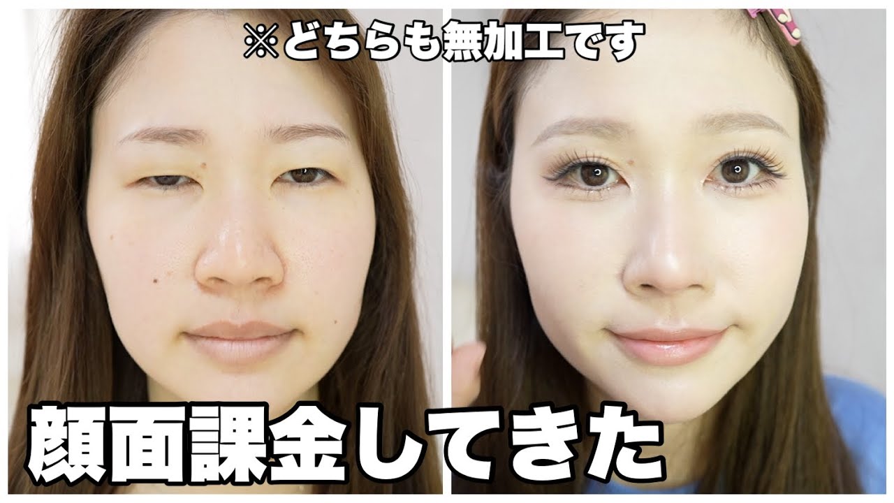 【ホクロ除去】金額は？痛みは？当日から現在までを紹介